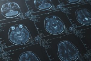 Traumatic brain injury lawsuit funding